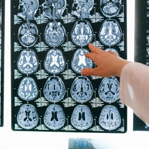 Kateri obrok dneva je najpomembnejši za zdravje možganov?