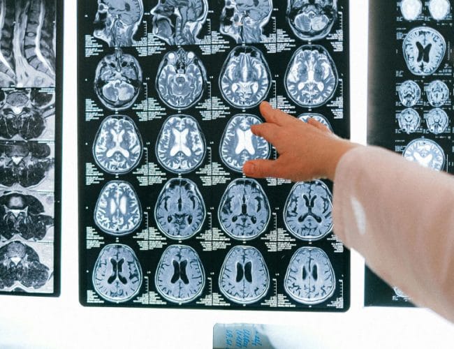 Kateri obrok dneva je najpomembnejši za zdravje možganov?