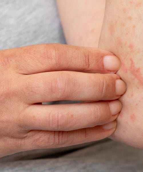 Garje: Vse, kar morate vedeti o tej nalezljivi kožni bolezni