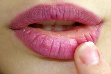 Največji razlog za razpokane ustnice – rešitev je presenetljivo preprosta