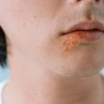 Herpes