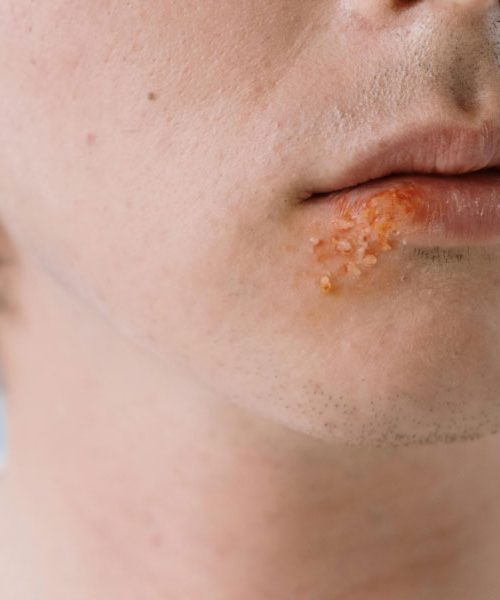 Najboljše zdravilo proti herpesu, ki ga že imate  doma