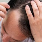 Pleša in izpadanje las