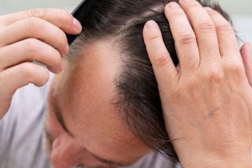 Znanstveniki so po naključju našli novo pot proti izpadanju las