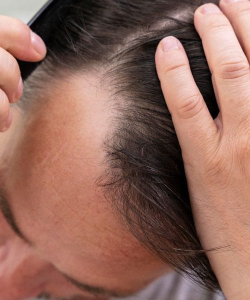 Znanstveniki so po naključju našli novo pot proti izpadanju las